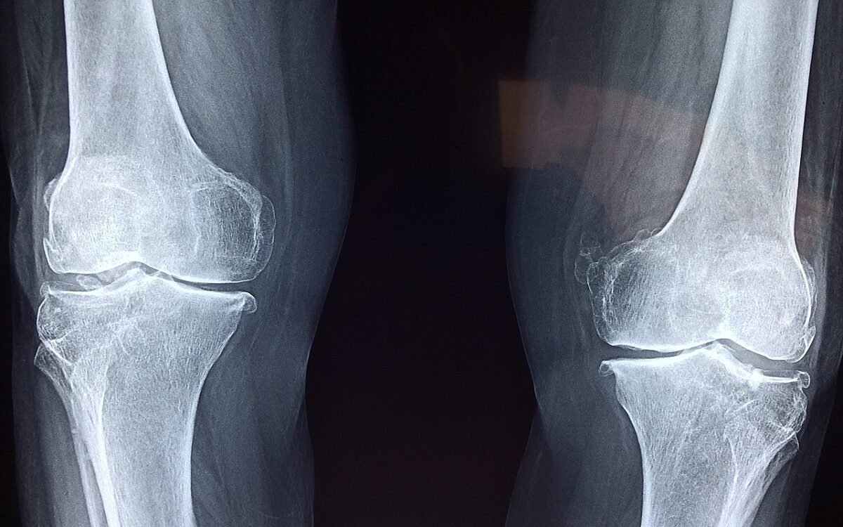 Ein Röntgenbild der Knie Ein Röntgenbild der Knie